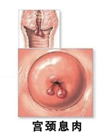 宮頸息肉的症狀